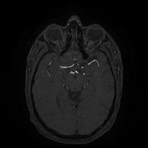 Carotid arterial dissection with acute cerebral infarction (Radiopaedia 26636-26784 MRA 94).jpg