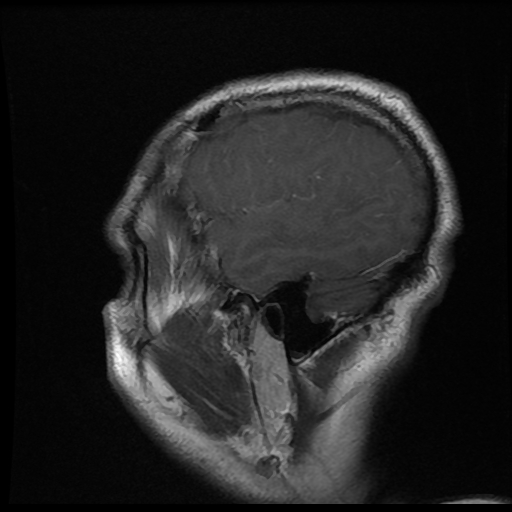 File:Carotid arterial dissection with acute cerebral infarction (Radiopaedia 26636-26784 Sagittal T1 C+ 18).jpg