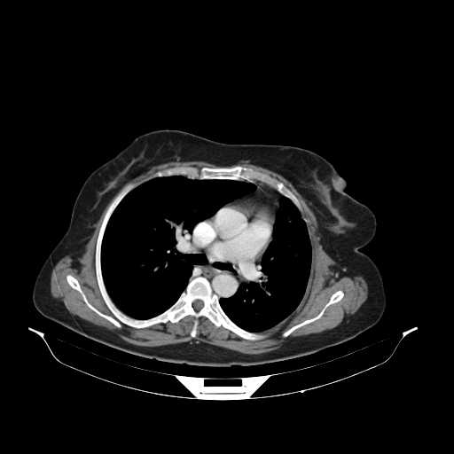Carotid body tumor (Radiopaedia 21021-20948 B 37).jpg