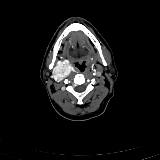 Carotid body tumor (Radiopaedia 83615-98727 A 50).jpg