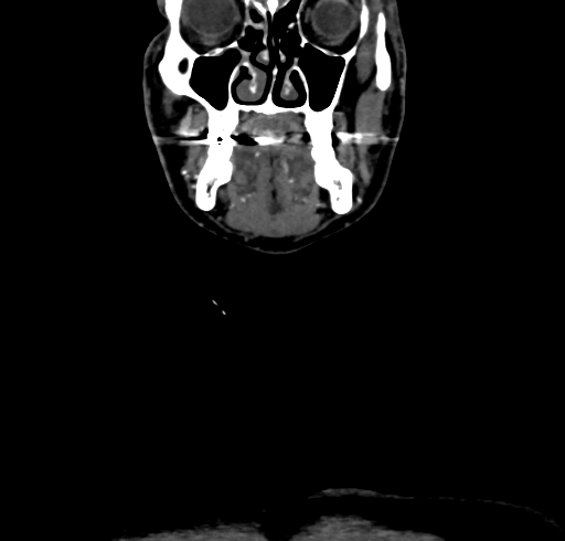 File:Carotid body tumor (Radiopaedia 83615-98727 B 21).jpg