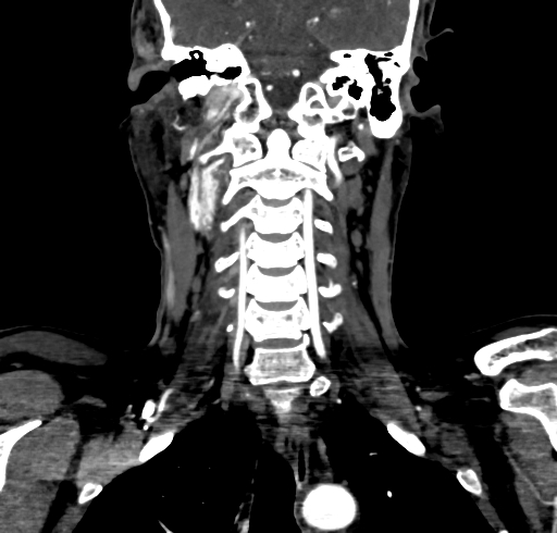 File:Carotid body tumor (Radiopaedia 83615-98727 B 79).jpg
