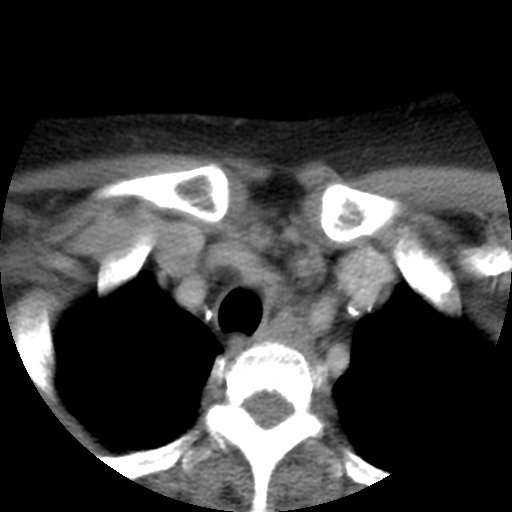 Carotid body tumor (paraganglioma) (Radiopaedia 38586-40729 A 31).jpg