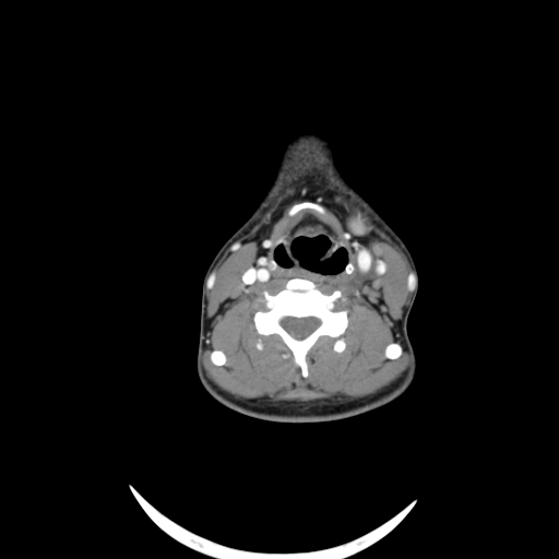 Carotid bulb pseudoaneurysm (Radiopaedia 57670-64616 A 41).jpg