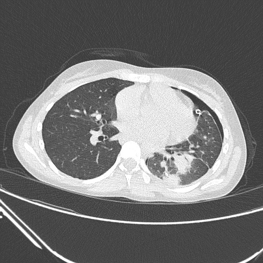 Catamenial pneumothorax (Radiopaedia 27946-28197 lung window 93).jpg