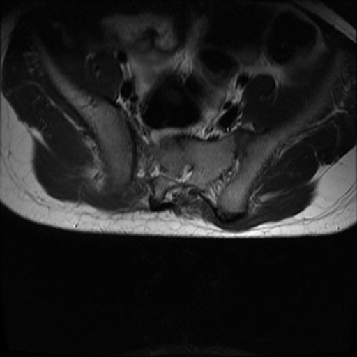 File:Caudal regression syndrome type 1 (Radiopaedia 82213-96267 Axial T2 23).jpg
