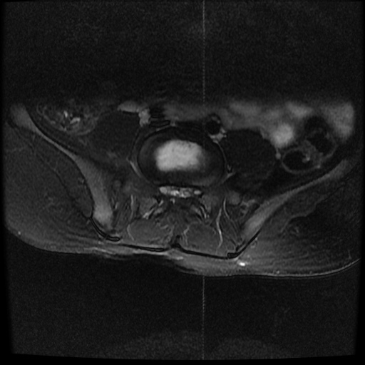 File:Caudal regression syndrome type 1 (Radiopaedia 82213-96267 Axial T2 fat sat 21).jpg