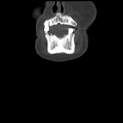 Causes of dysphagia (Radiopaedia 40149-42657 Coronal bone window 8).png