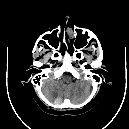 Cavernous hemangioma of the cerebellar falx (Radiopaedia 73025-83723 Axial non-contrast 21).jpg