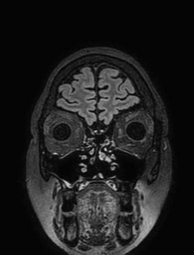 Cavernous hemangioma of the cerebellar falx (Radiopaedia 73025-83724 Coronal FLAIR 39).jpg