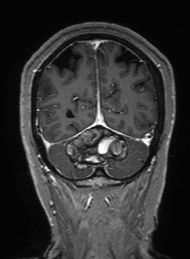 Cavernous hemangioma of the cerebellar falx (Radiopaedia 73025-83724 Coronal T1 C+ 305).jpg