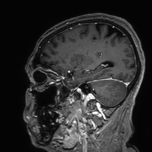 Cavernous hemangioma of the cerebellar falx (Radiopaedia 73025-83724 Sagittal T1 C+ 65).jpg
