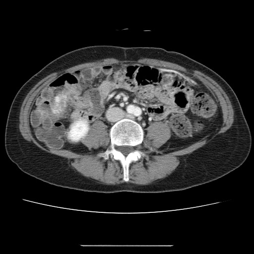 File:Cavernous hepatic hemangioma (Radiopaedia 75441-86667 B 67).jpg