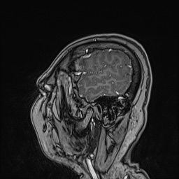 Cavernous sinus meningioma (Radiopaedia 63682-72367 Sagittal T1 C+ 38).jpg