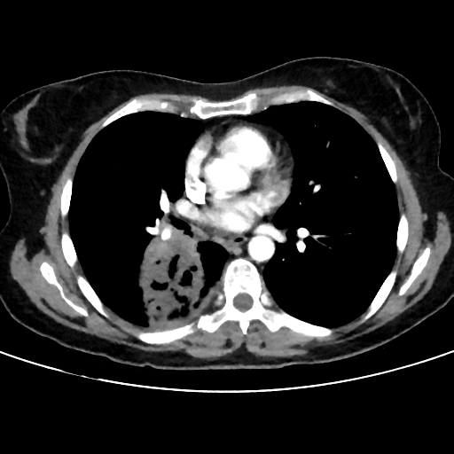 File:Cavitating lung mass - squamous cell carcinoma (Radiopaedia 48047-52854 B 26).png