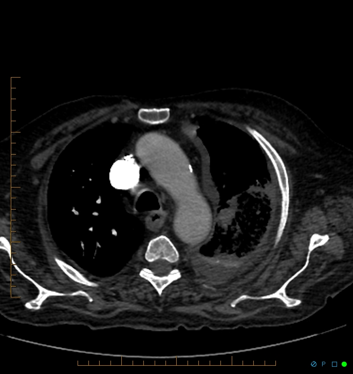 Cavitating pulmonary infarction (Radiopaedia 54634-60849 Axial C+ CTPA 14).jpg