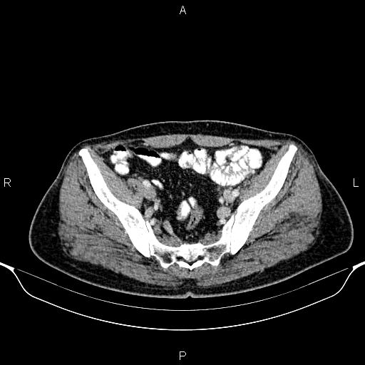 Cecal adenocarcinoma (Radiopaedia 85324-100916 B 80).jpg