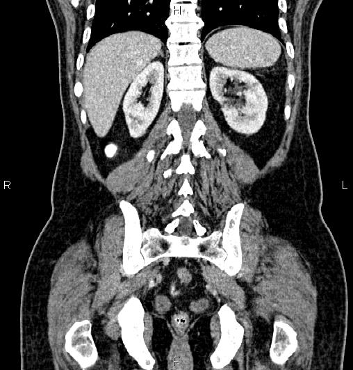 Cecal adenocarcinoma (Radiopaedia 85324-100916 D 50).jpg