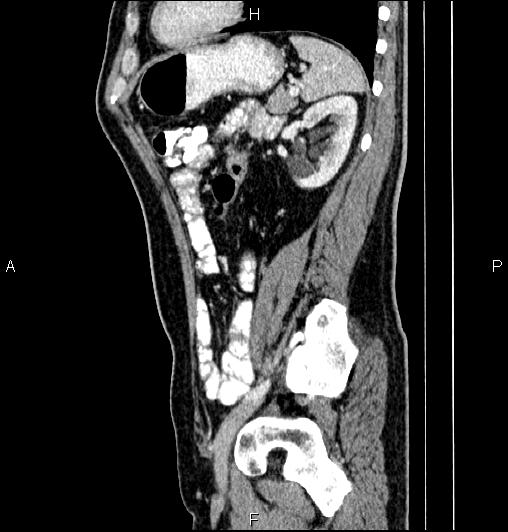 Cecal adenocarcinoma (Radiopaedia 85324-100916 E 66).jpg