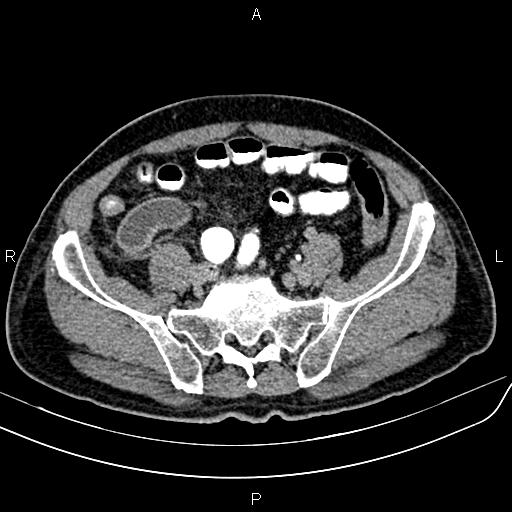 File:Cecal cancer with appendiceal mucocele (Radiopaedia 91080-108651 Axial C+ delayed 58).jpg