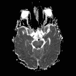 File:Central-variant posterior reversible encephalopathy syndrome (PRES) (Radiopaedia 43880-47358 Axial ADC 8).jpg