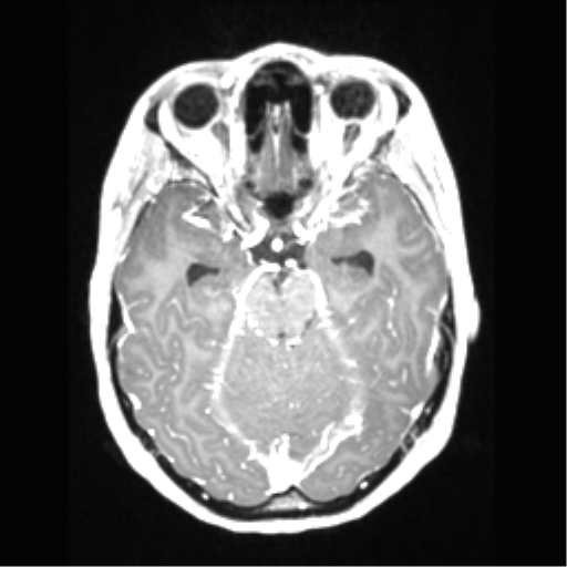 Central neurocytoma (Radiopaedia 37664-39557 Axial T1 C+ 30).png
