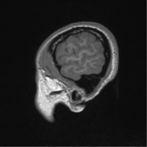 Central neurocytoma (Radiopaedia 37664-39557 Sagittal T1 13).png