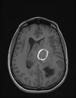 Central neurocytoma (Radiopaedia 84497-99872 Axial T1 121).jpg