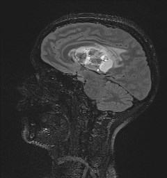 Central neurocytoma (Radiopaedia 84497-99872 Sagittal Flair + Gd 70).jpg