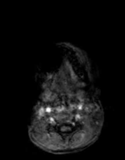 Cerebellar abscess (Radiopaedia 73727-84563 Axial T1 C+ fat sat 3).jpg
