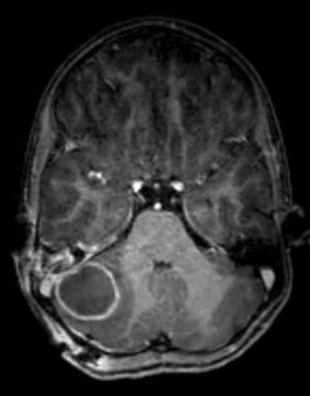 Cerebellar abscess (Radiopaedia 73727-84563 Axial T1 C+ fat sat 48).jpg