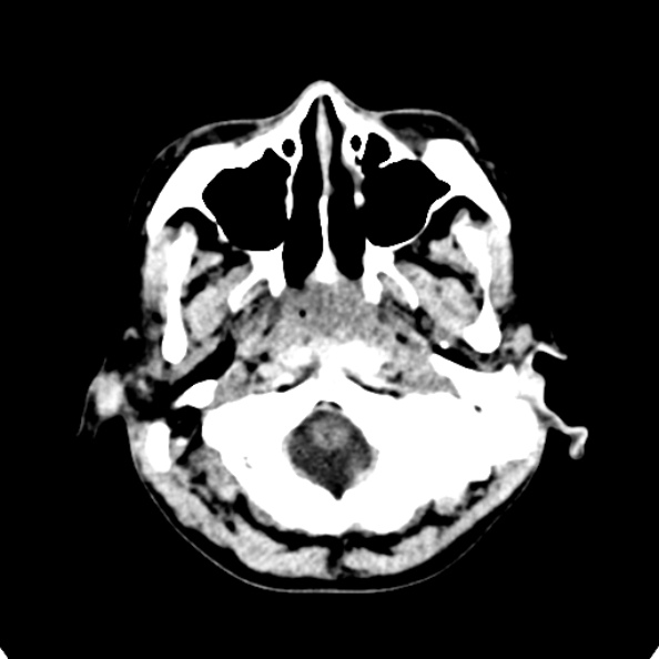 Cerebellar abscess secondary to mastoiditis (Radiopaedia 26284-26412 Axial non-contrast 12).jpg