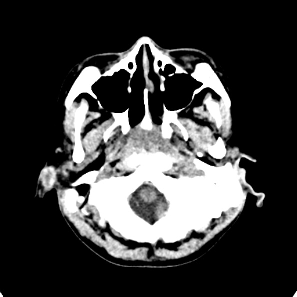 Cerebellar abscess secondary to mastoiditis (Radiopaedia 26284-26412 Axial non-contrast 13).jpg