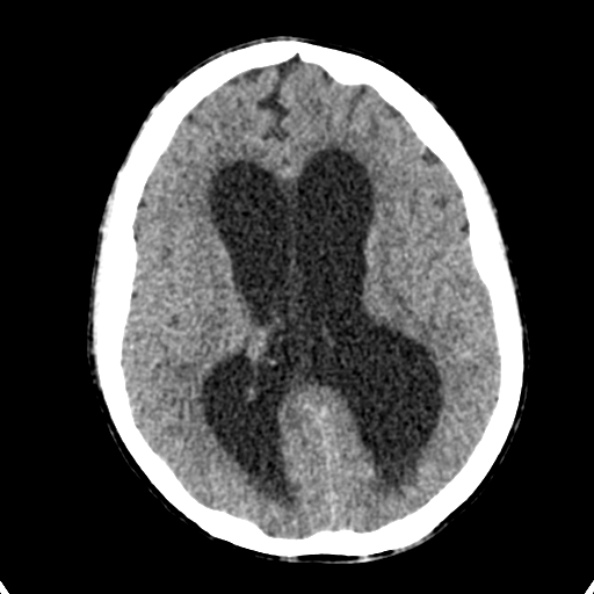 File:Cerebellar abscess secondary to mastoiditis (Radiopaedia 26284-26412 Axial non-contrast 90).jpg