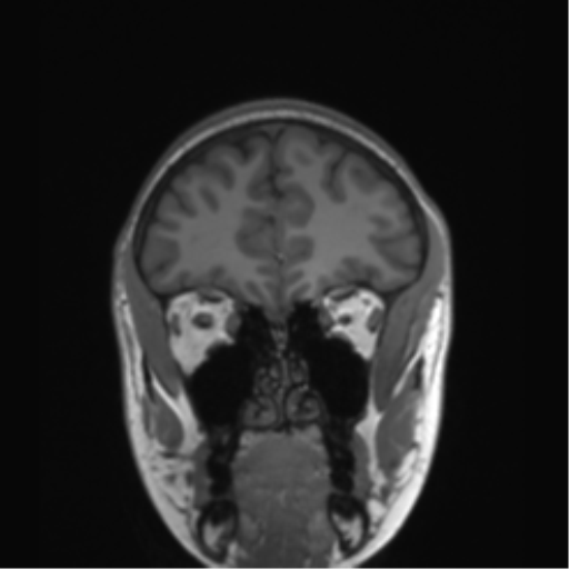 Cerebellar agenesis with hypoplastic pons (pontocerebellar hypoplasia) (Radiopaedia 57224-64138 Coronal T1 73).png