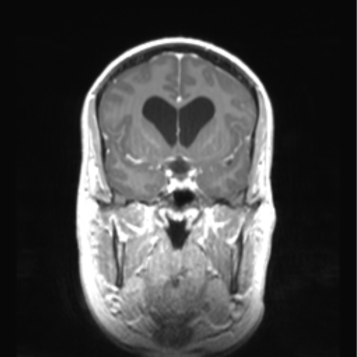 Cerebellar ependymoma complicated by post-operative subdural hematoma (Radiopaedia 83322-97736 Coronal T1 C+ 21).png