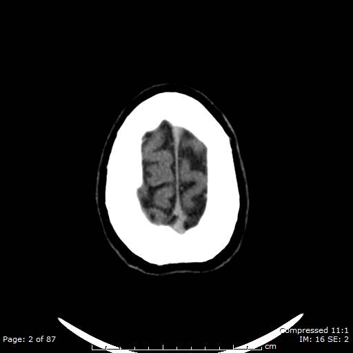 Cerebellar hemangioblastoma (Radiopaedia 52360-58258 Axial non-contrast 2).jpg