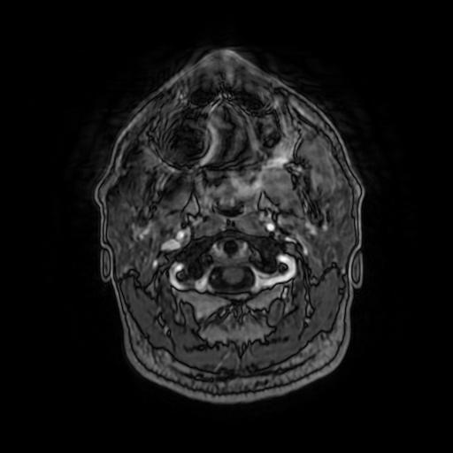 Cerebellar hemangioblastoma (Radiopaedia 88055-104622 Axial T1 C+ 18).jpg