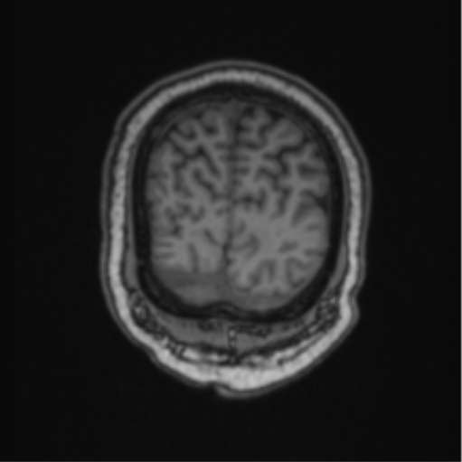 File:Cerebellar hemangioblastomas and pituitary adenoma (Radiopaedia 85490-101176 Coronal T1 18).png