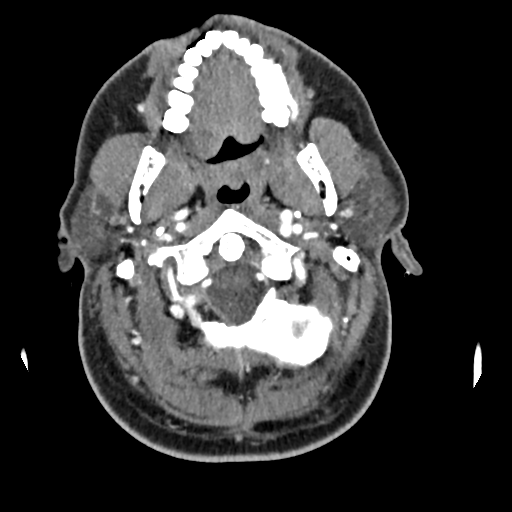 Cerebellar infarct due to vertebral artery dissection with posterior fossa decompression (Radiopaedia 82779-97029 C 55).png
