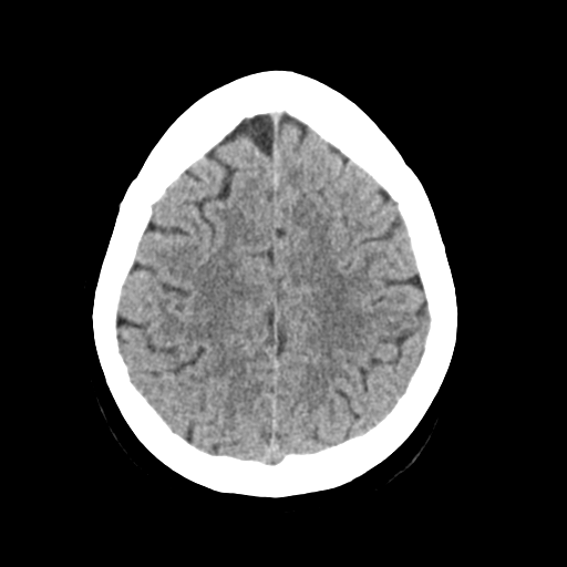 Cerebellar metastasis (Radiopaedia 54578-60812 Axial non-contrast 39).png