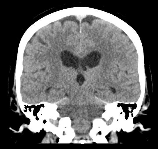 Cerebellar metastasis (Radiopaedia 54578-60812 Coronal non-contrast 33).png