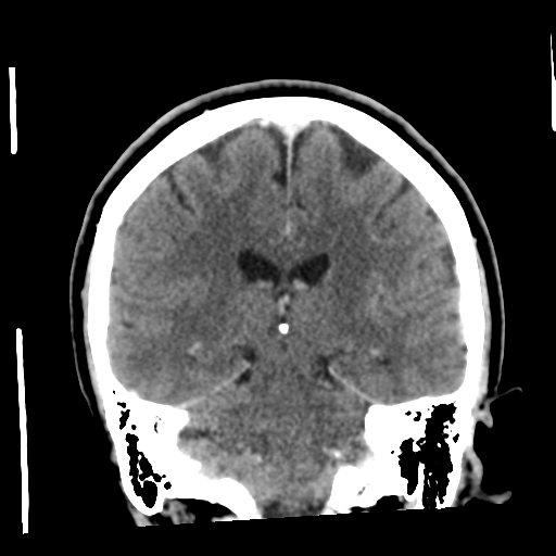 Cerebellar metastasis (cystic appearance) (Radiopaedia 41395-44258 D 38).png