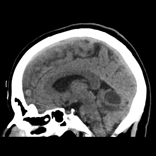 Cerebellar metastasis (cystic appearance) (Radiopaedia 41395-44258 E 30).png