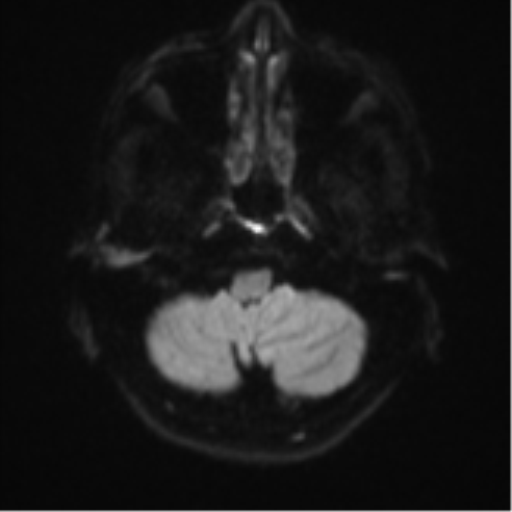 Cerebellar metastasis - adenocarcinoma lung (Radiopaedia 63184-71715 Axial DWI 32).png