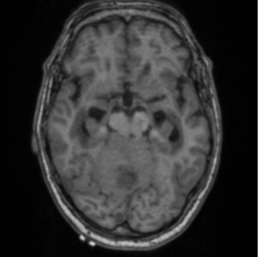 Cerebellar metastasis from lung adenocarcinoma (Radiopaedia 86690-102829 Axial T1 34).png
