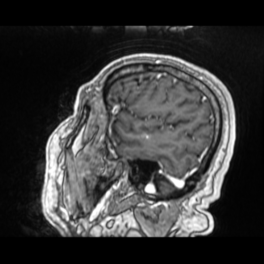 Cerebellar metastasis of pulmonary adenocarcinoma, cavernous venous malformation, and developmental venous anomaly (Radiopaedia 85827-101661 Sagittal T1 C+ 76).jpg