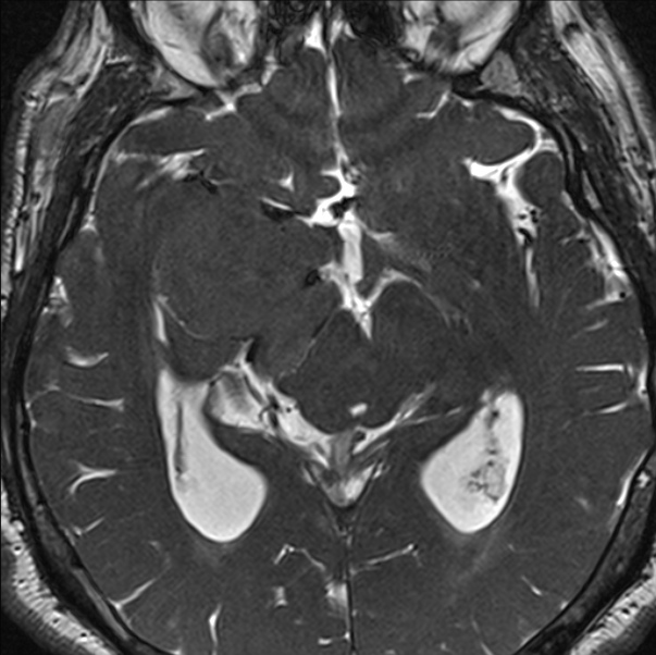 Cerebellopontine angle meningioma (Radiopaedia 24459-24764 I 46).jpg