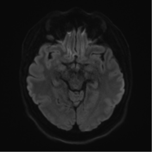 Cerebellopontine angle meningioma (Radiopaedia 48434-53348 Axial DWI 52).png