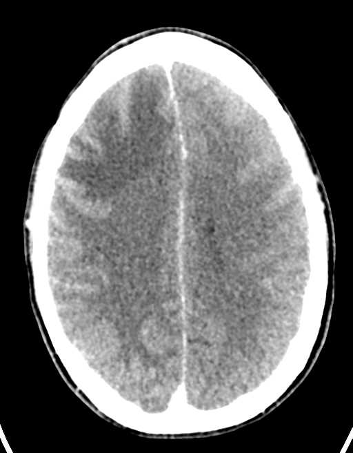 Cerebral abscess (Radiopaedia 60342-68008 Axial C+ delayed 34).png